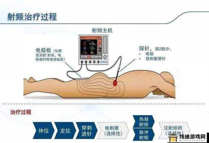 日本HRS射频技术在医疗领域的应用与发展